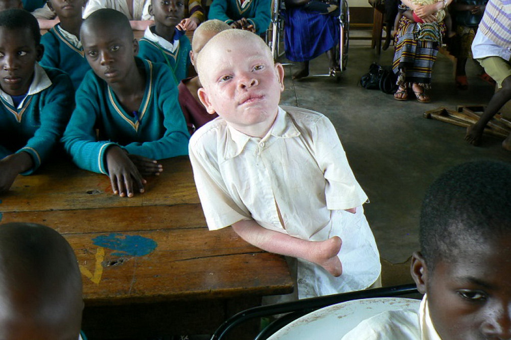 Фото африканцы альбиносы