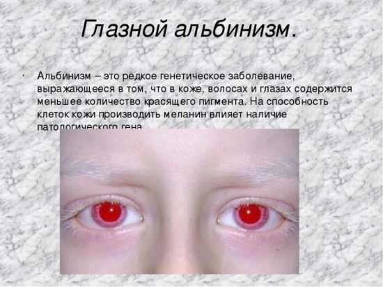 Альбинизм глаза